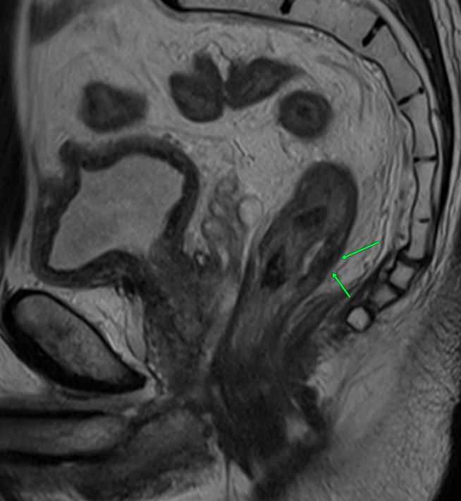 Рак Прямой кишки. Оценка эффективности неоадъювантного лечения (система Tumour Regression Grade – TRG)